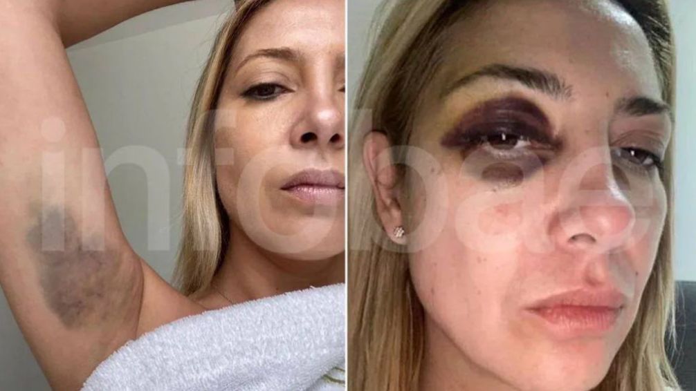 Evidencia. Imágenes de las lesiones que le habría ocasionado el ex Presidente a Fabiola Yañez.