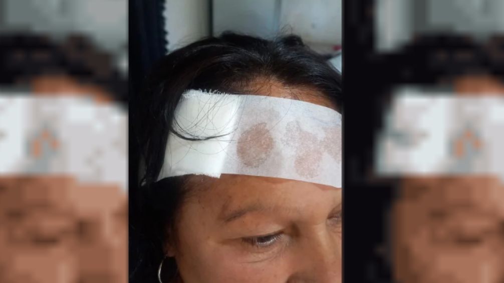 Violento asalto en La Plata: golpearon a una mujer con una pistola y le fracturaron la muñeca
