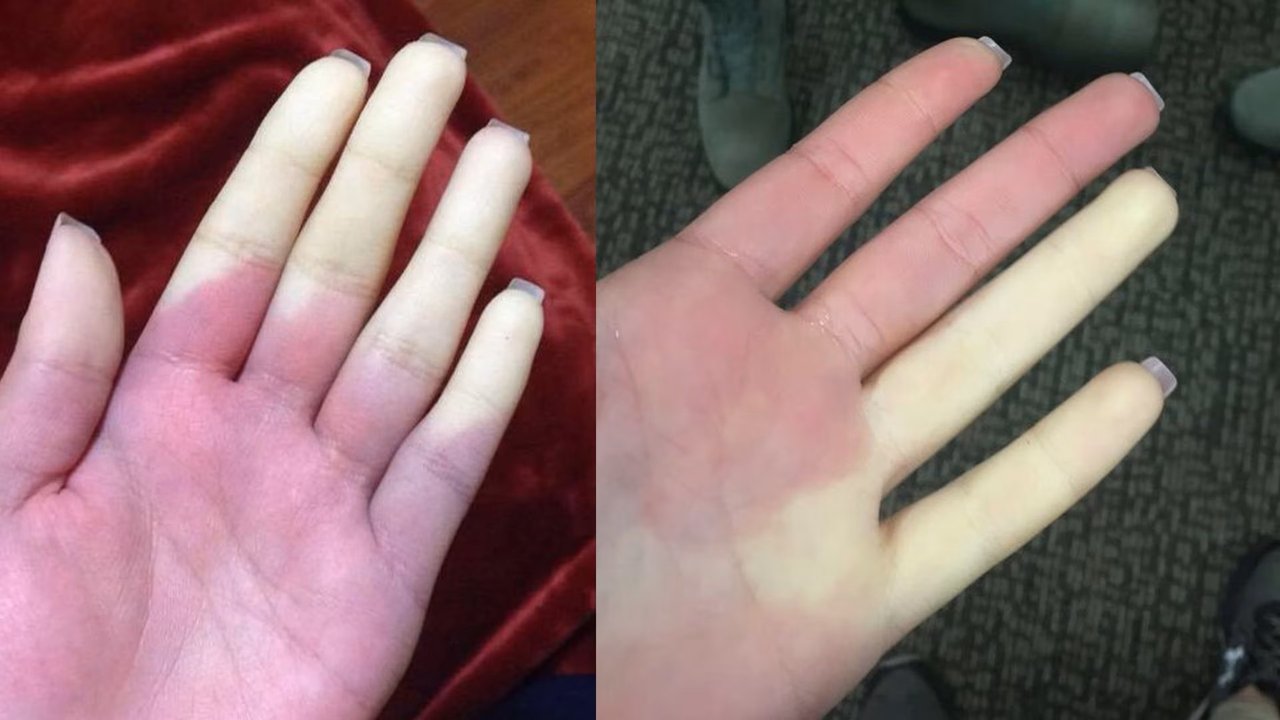 Sistema de Raynaud: manos y pies helados… y no por el frío