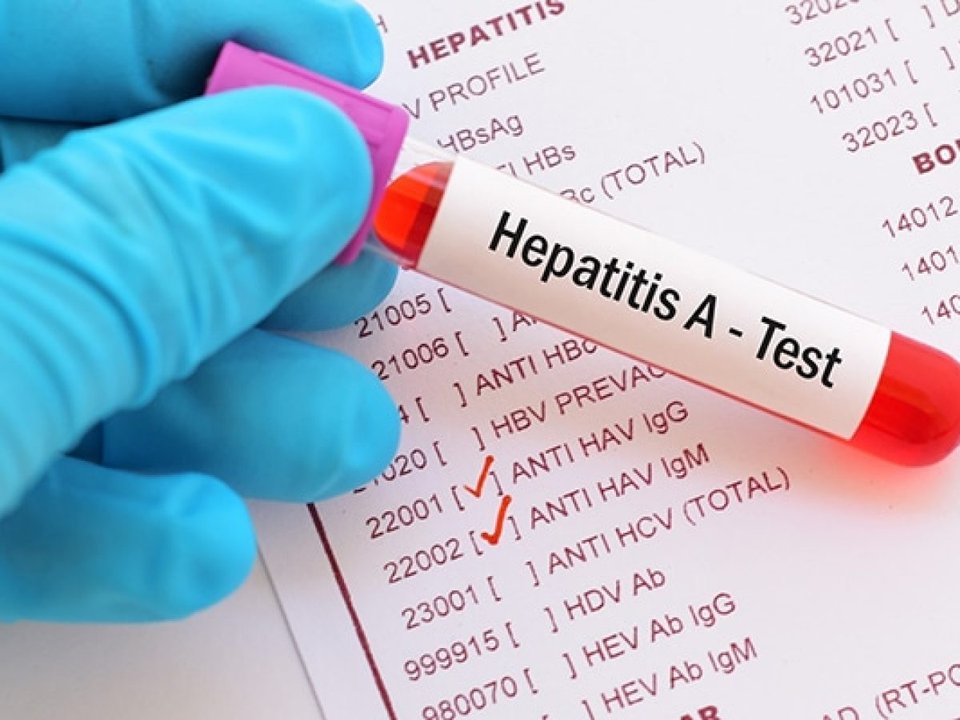 Advierten por fuertes subas de casos en Hepatitis A 